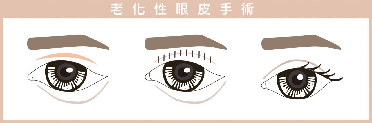 老化性眼皮手術方式詳解