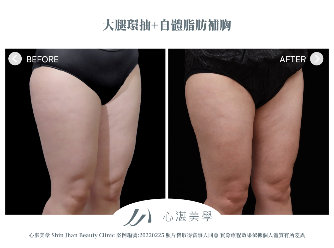 大腿環抽+自體脂肪補胸 術前術後案例分享