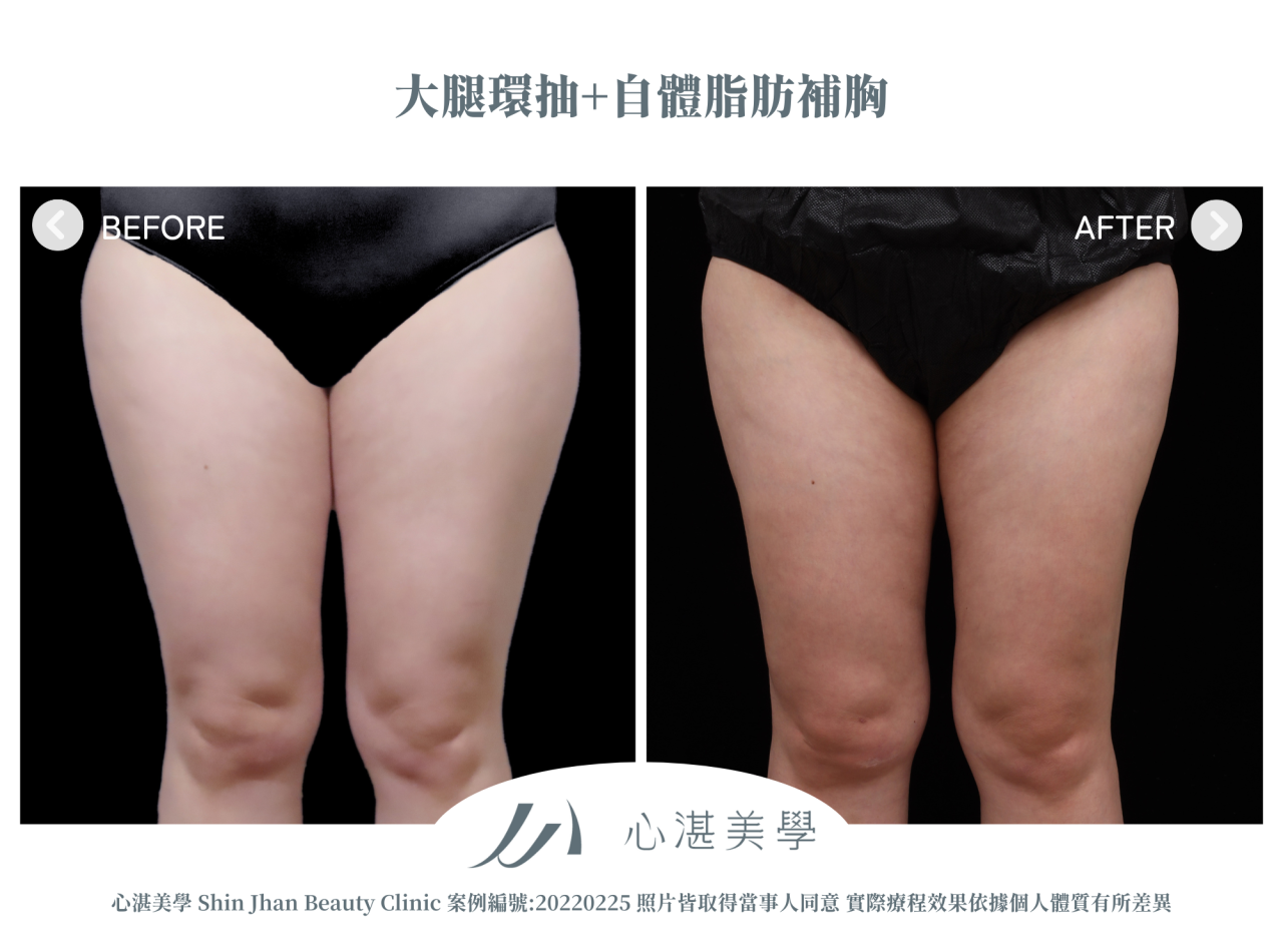 大腿環抽+自體脂肪補胸 術前術後案例分享