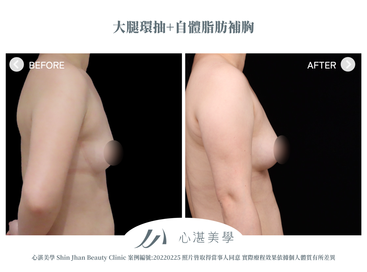 大腿環抽+自體脂肪補胸 術前術後案例分享