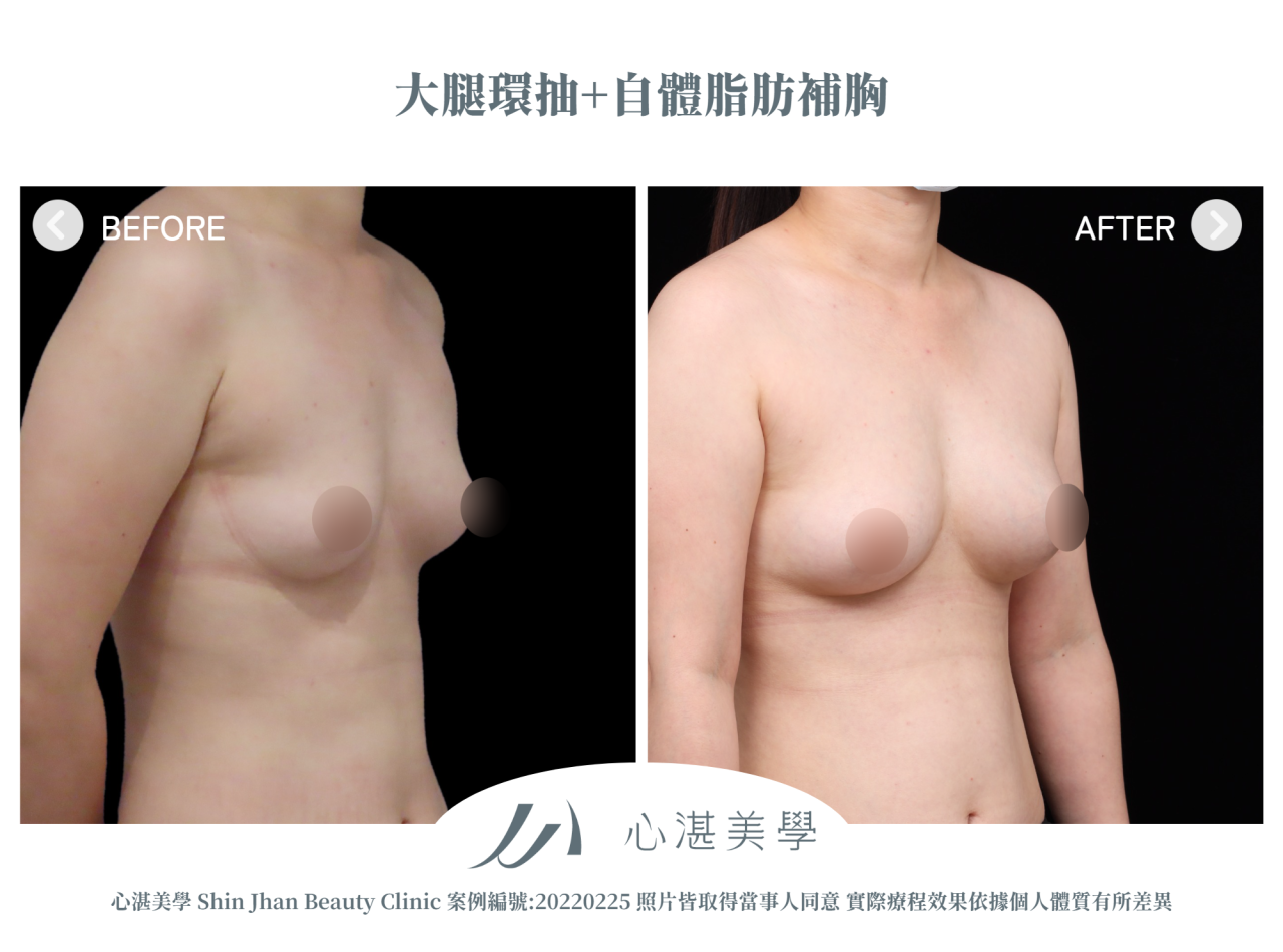 大腿環抽+自體脂肪補胸 術前術後案例分享
