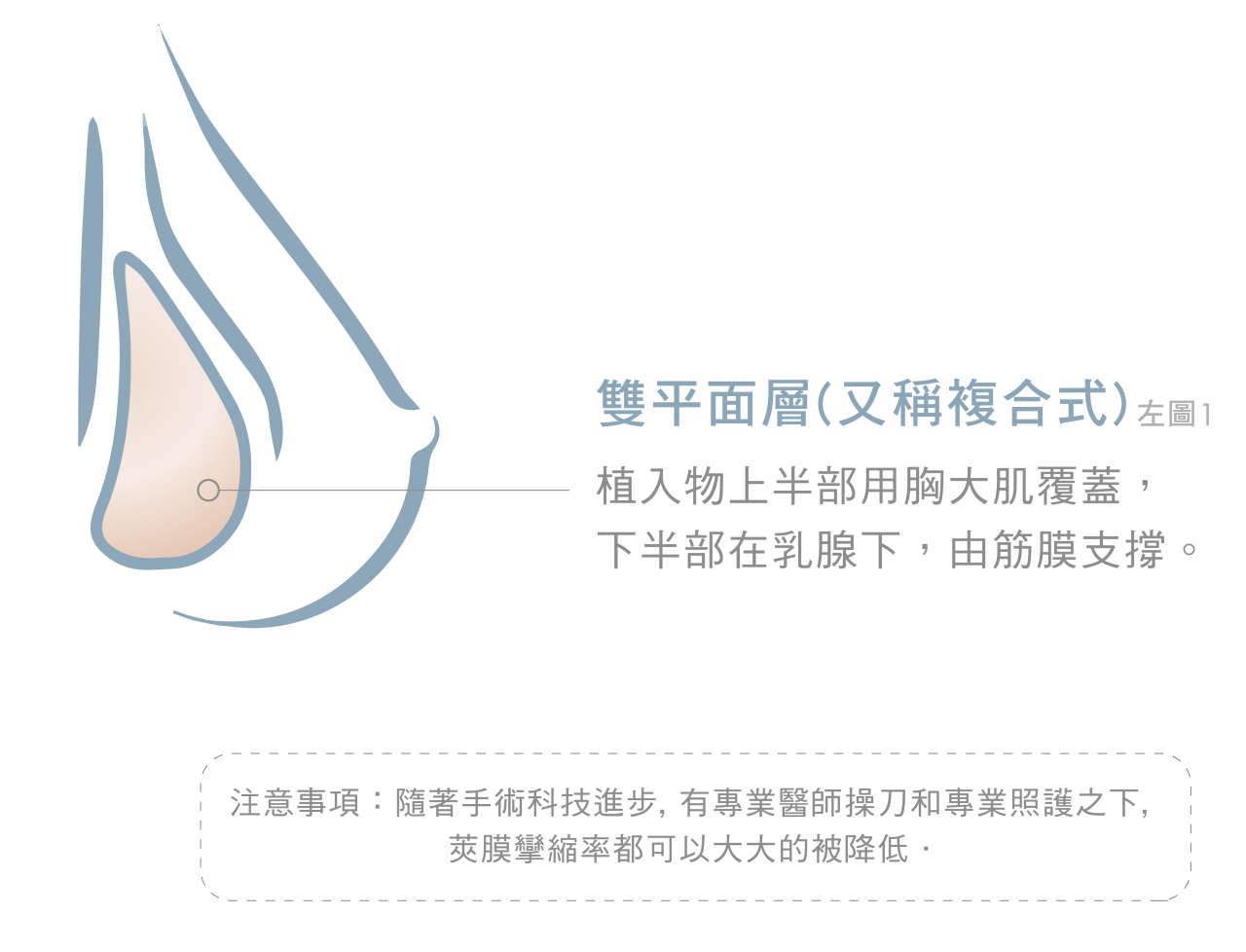 光滑面的記憶果凍容易造成莢膜攣縮嗎?