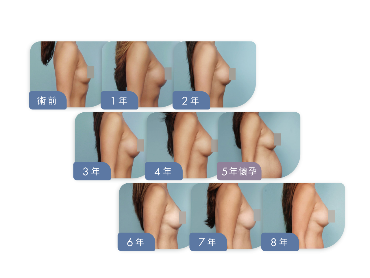 隆乳會因為年紀/哺乳而產生變化嗎?