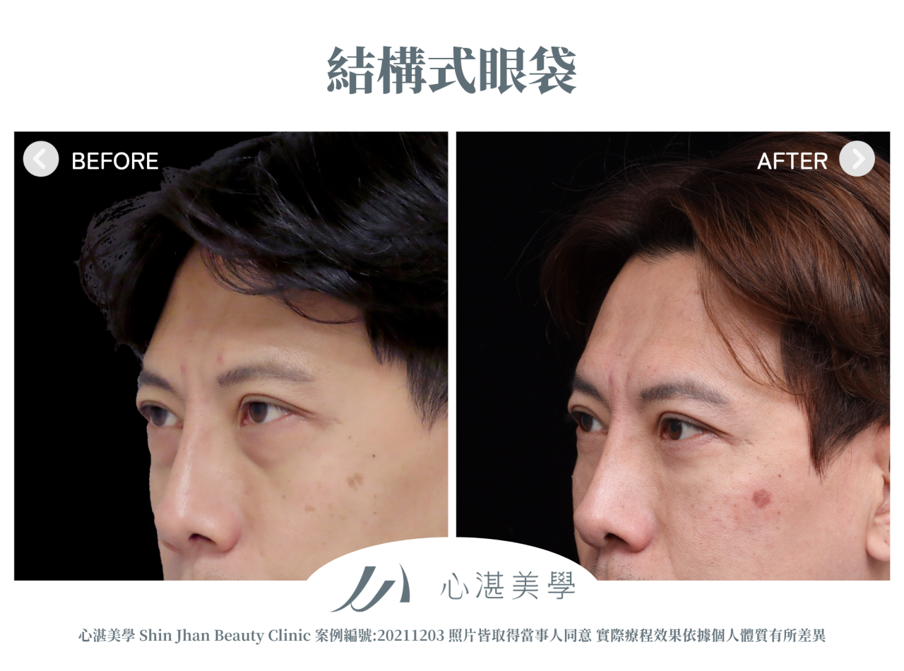 結構式眼袋(眼袋內開+眼尾拉提定位+自體脂肪補淚溝蘋果肌) 術前術後案例分享