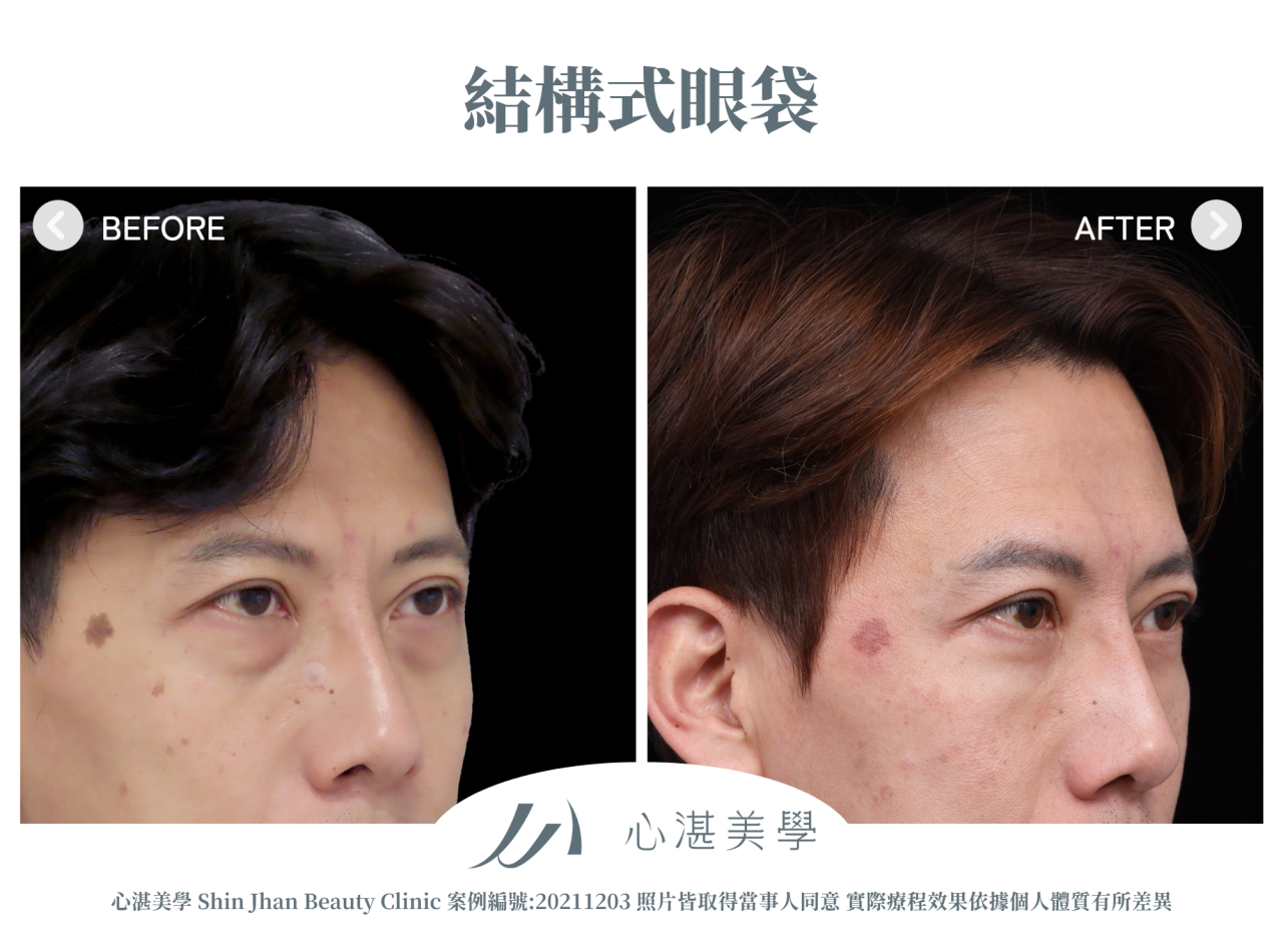 結構式眼袋(眼袋內開+眼尾拉提定位+自體脂肪補淚溝蘋果肌) 術前術後案例分享