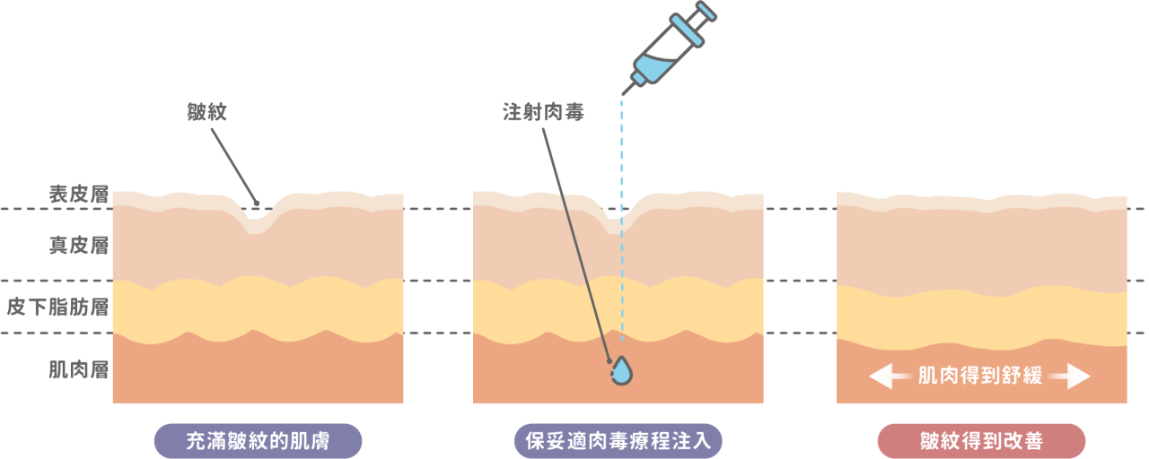 保妥適是一種神經傳導阻斷劑。 注射後，它會與神經末梢結合，抑制乙醯膽鹼的釋放，而乙醯膽鹼是神經傳導至肌肉使其收縮的物質。 透過阻斷神經訊號，目標肌肉會暫時放鬆，進而減少因過度活躍而形成的皺紋，使皮膚恢復平滑。