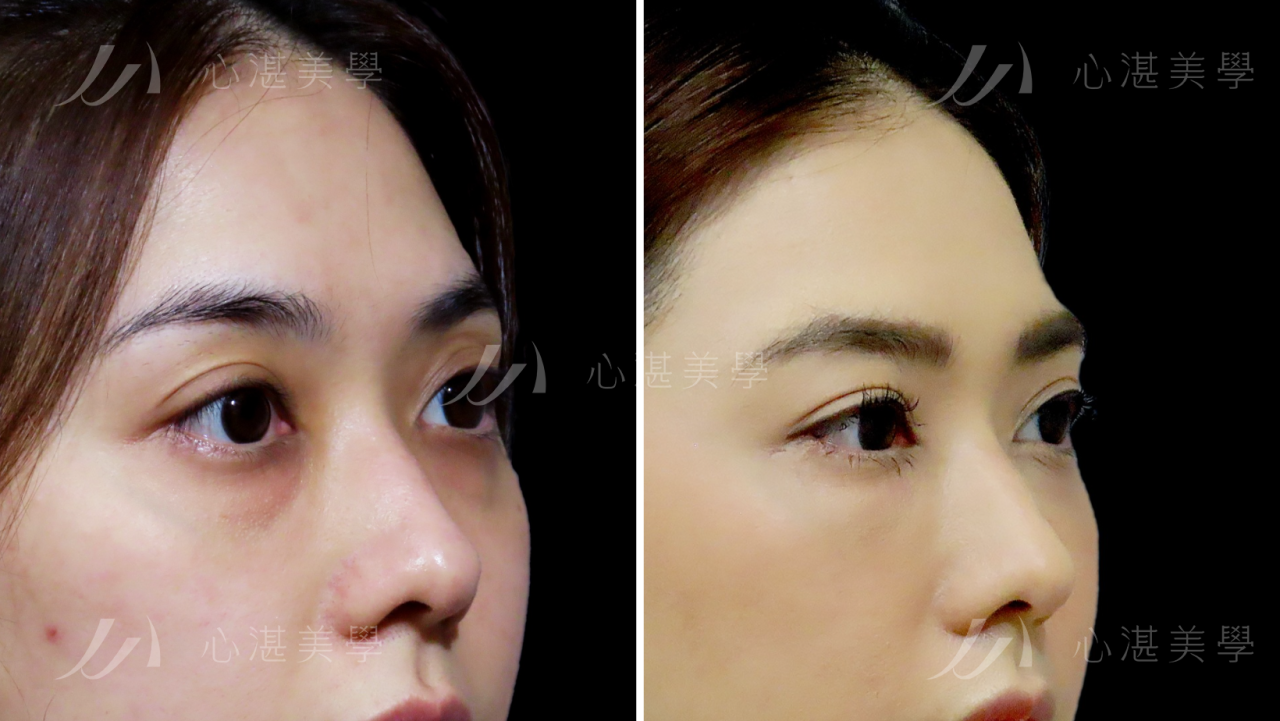 解決連婚秘都認證過難遮瑕的眼袋！結構式眼袋手術讓我瞬間變年輕
