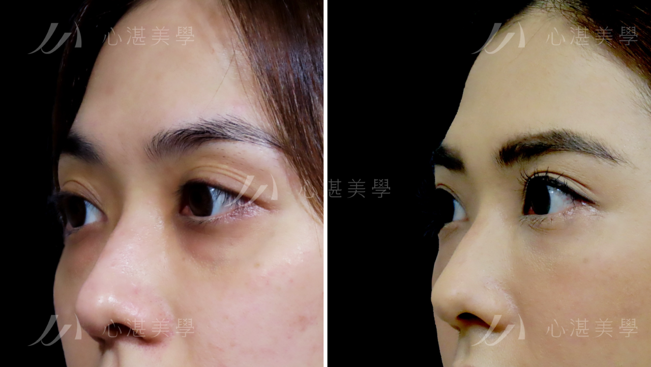 解決連婚秘都認證過難遮瑕的眼袋！結構式眼袋手術讓我瞬間變年輕