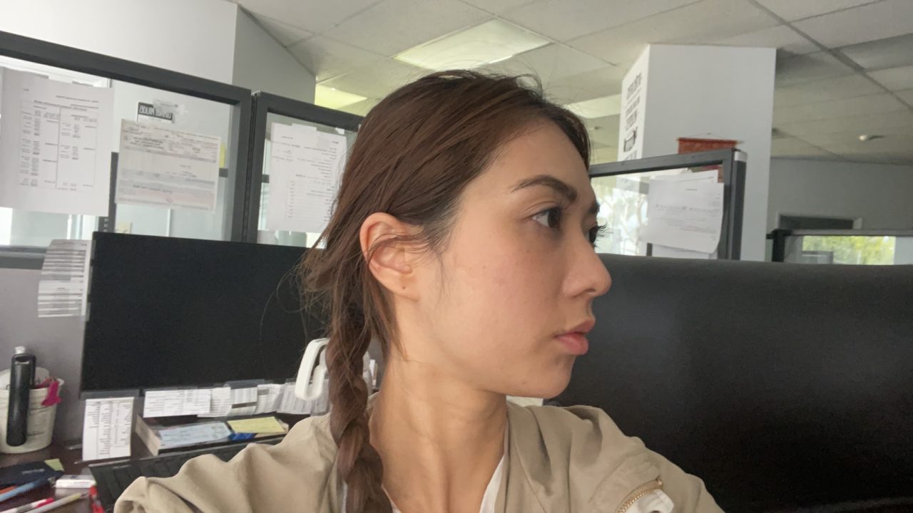 解決連婚秘都認證過難遮瑕的眼袋！結構式眼袋手術讓我瞬間變年輕
