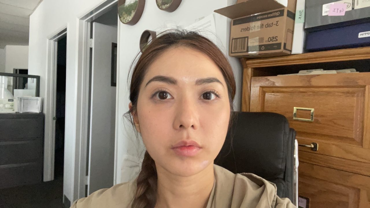 解決連婚秘都認證過難遮瑕的眼袋！結構式眼袋手術讓我瞬間變年輕