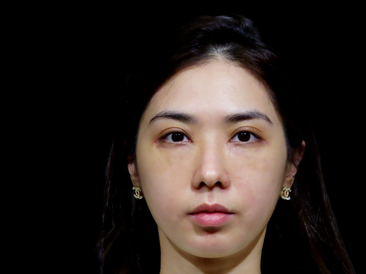 解決連婚秘都認證過難遮瑕的眼袋！結構式眼袋手術讓我瞬間變年輕