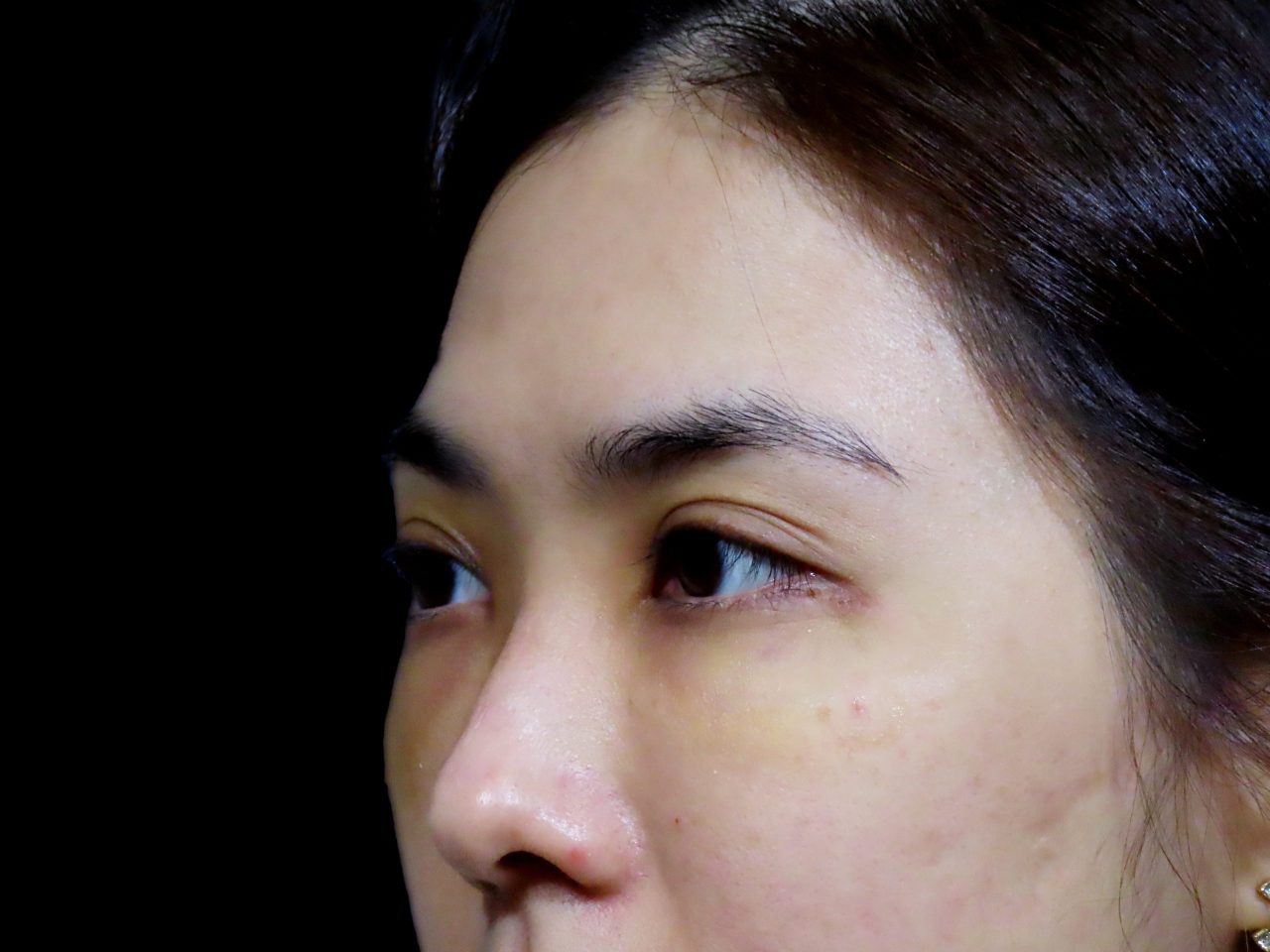 解決連婚秘都認證過難遮瑕的眼袋！結構式眼袋手術讓我瞬間變年輕