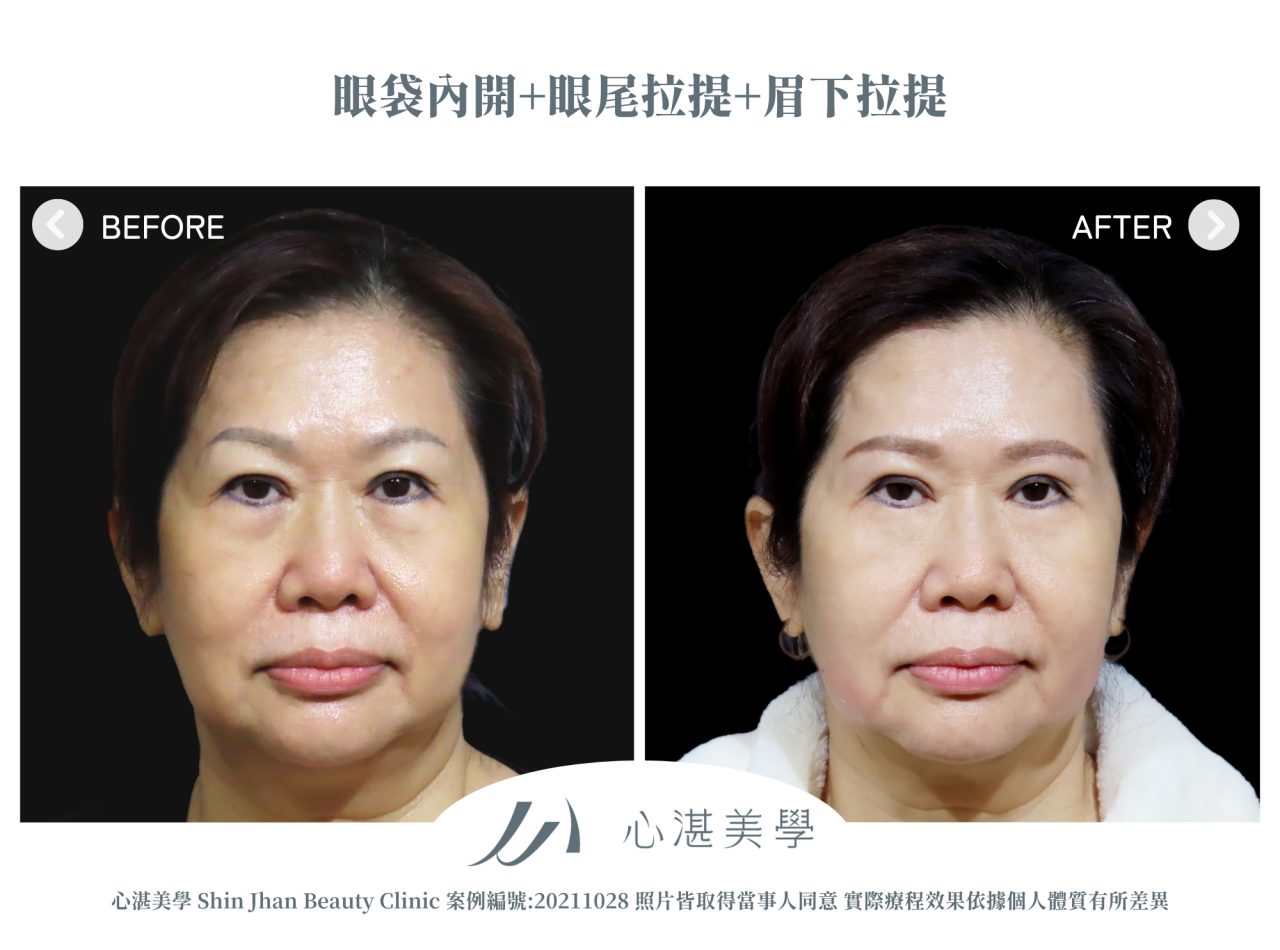 微創提眉手術(眉下切皮)+眼袋內開+眼尾拉提定位 術前術後案例分享