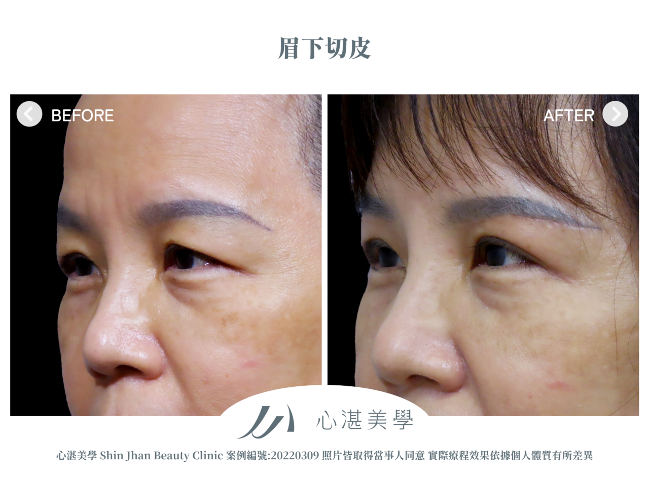 微創提眉手術(眉下切皮) 術前術後案例分享