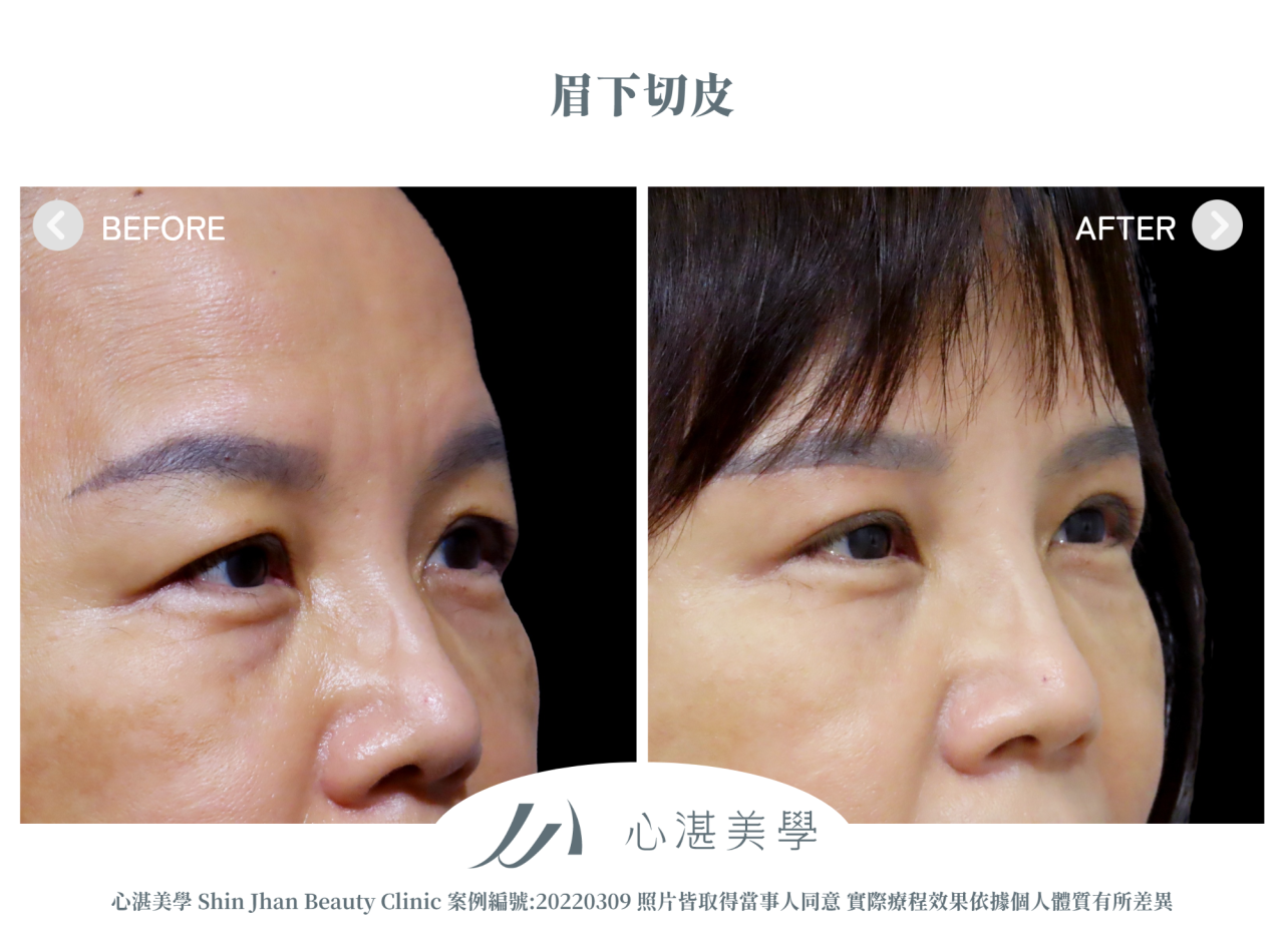 微創提眉手術(眉下切皮) 術前術後案例分享