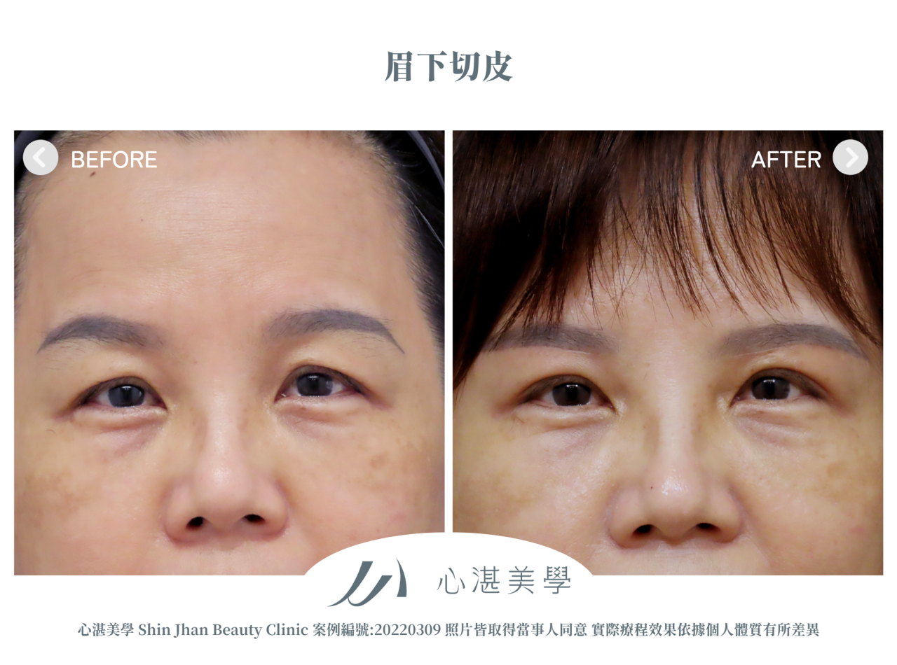 微創提眉手術(眉下切皮) 術前術後案例分享