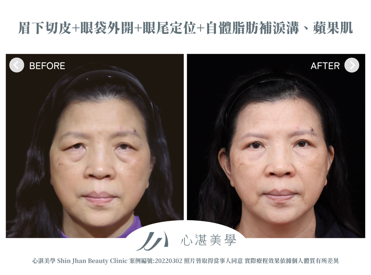 微創提眉手術(眉下切皮)+結構式眼袋(眼袋外開+眼尾拉提定位+自體脂肪補淚溝) 術前術後案例分享