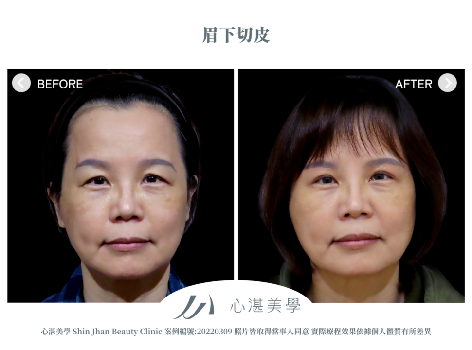 微創提眉手術(眉下切皮) 術前術後案例分享