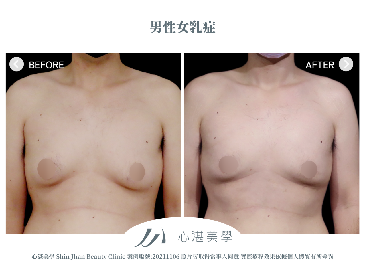 男性女乳術前術後案例分享