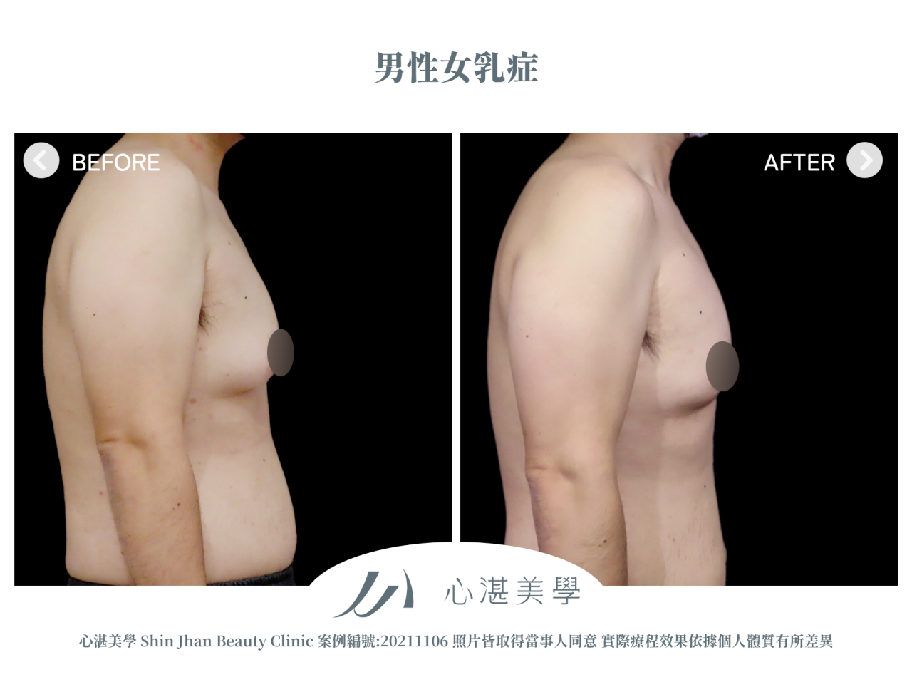 男性女乳術前術後案例分享