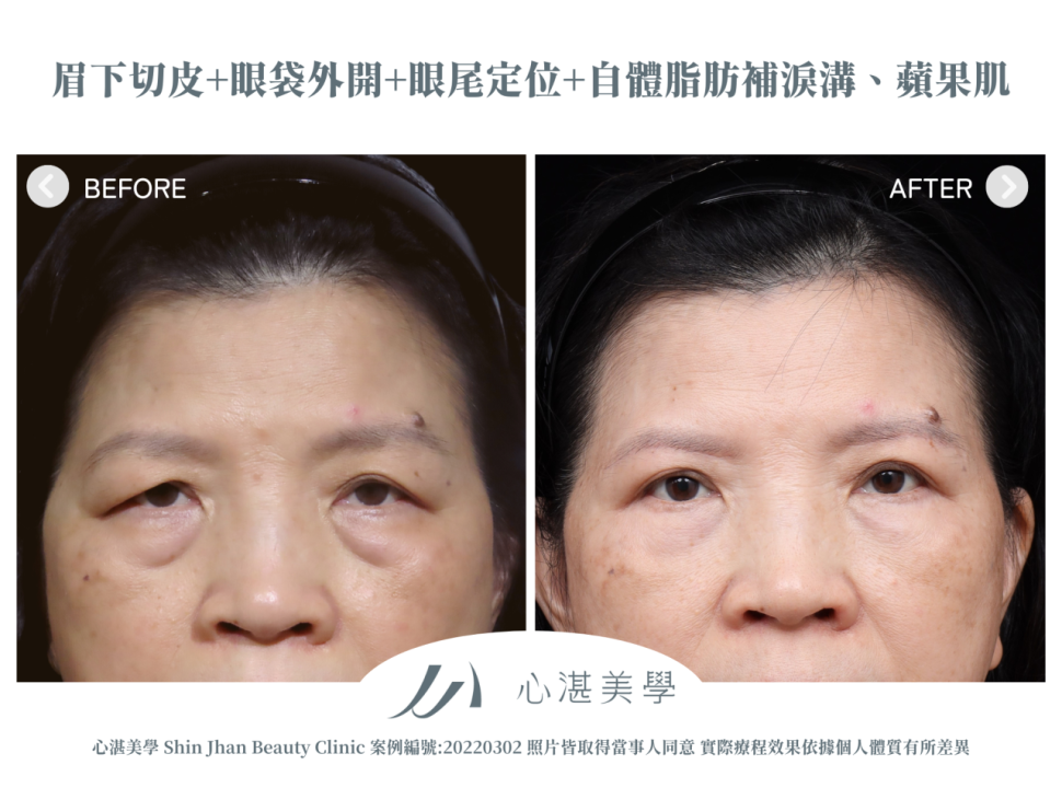 微創提眉術(眉下切皮)+結構式眼袋(眼袋外開+眼尾拉提定位+自體脂肪補淚溝蘋果肌) 術前術後案例分享