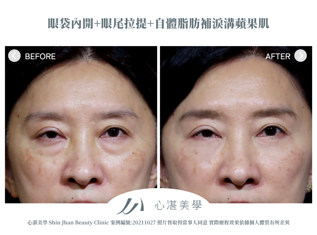 結構式眼袋(眼袋內開+眼尾拉提定位+自體脂肪補淚溝蘋果肌) 術前術後案例分享