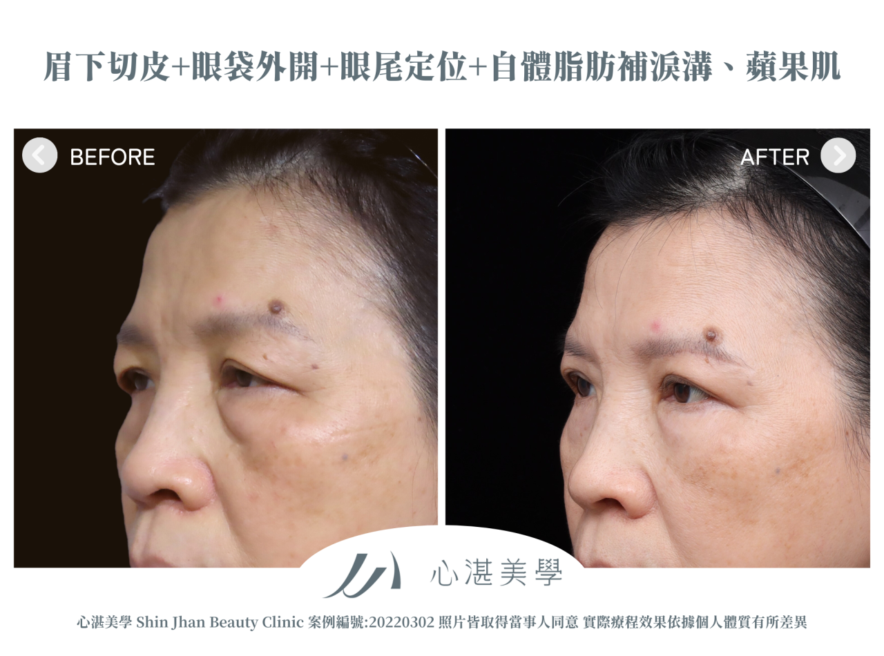 微創提眉術(眉下切皮)+結構式眼袋(眼袋外開+眼尾拉提定位+自體脂肪補淚溝蘋果肌) 術前術後案例分享