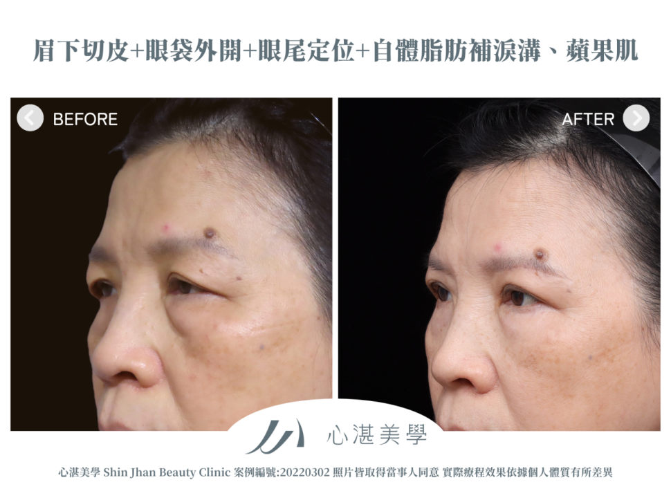 微創提眉術(眉下切皮)+結構式眼袋(眼袋外開+眼尾拉提定位+自體脂肪補淚溝蘋果肌) 術前術後案例分享