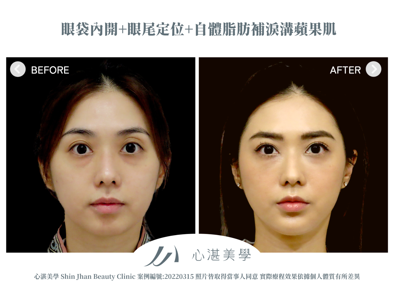 結構式眼袋(眼袋內開+眼尾拉提定位+自體脂肪補淚溝蘋果肌) 術前術後案例分享