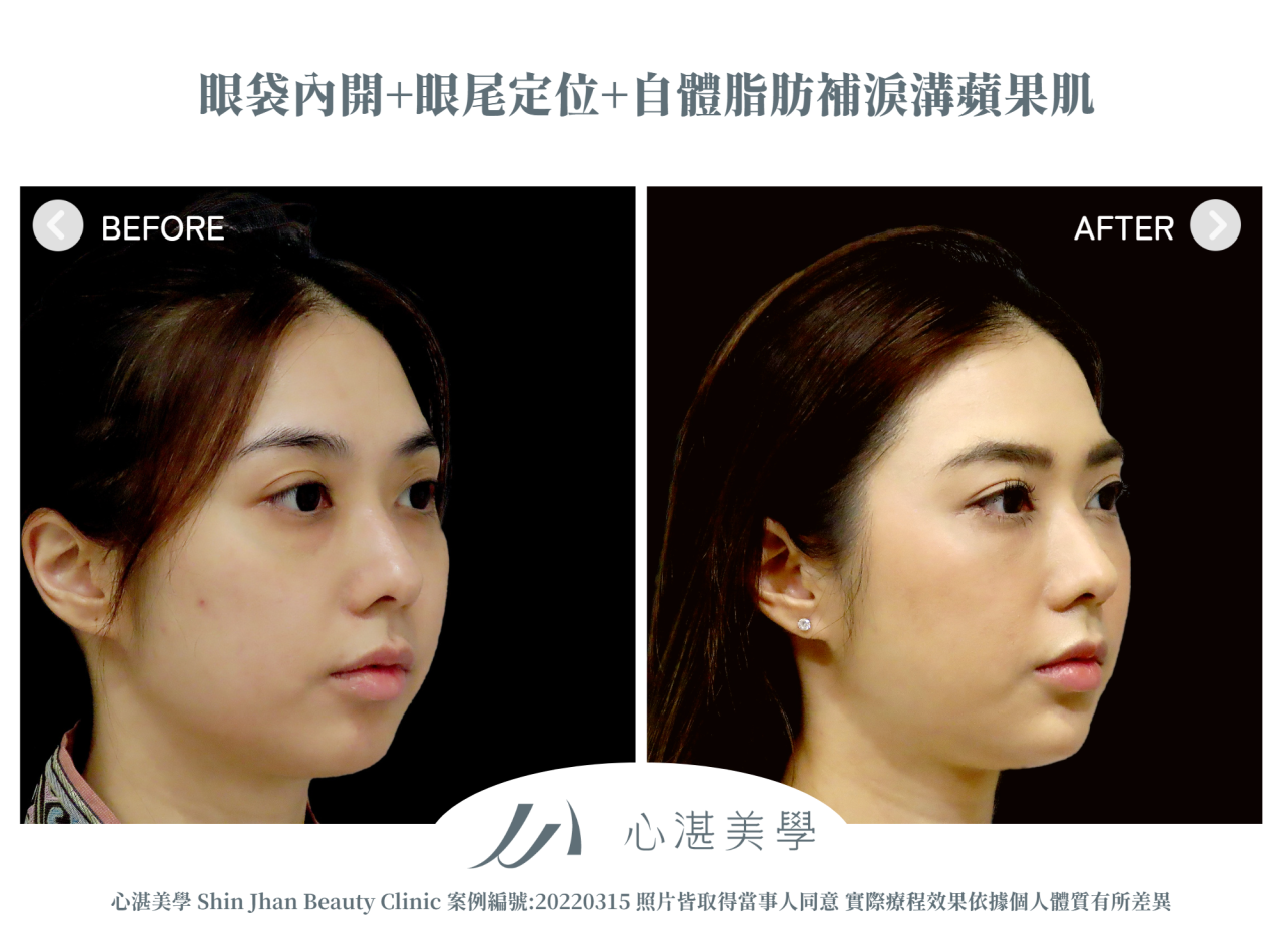 結構式眼袋(眼袋內開+眼尾拉提定位+自體脂肪補淚溝蘋果肌) 術前術後案例分享