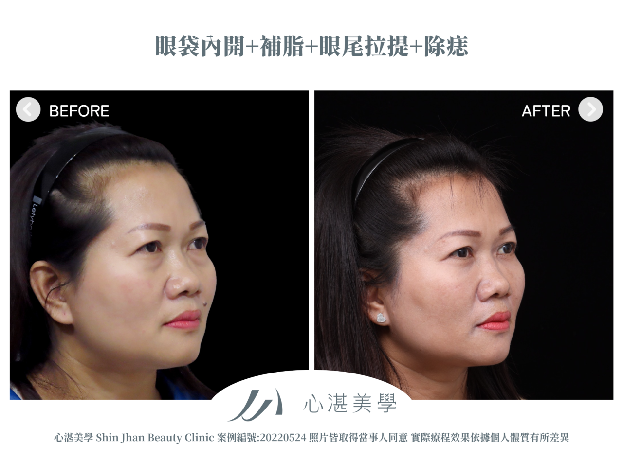 結構式眼袋(眼袋內開+眼尾拉提定位+自體脂肪補淚溝蘋果肌) 術前術後案例分享