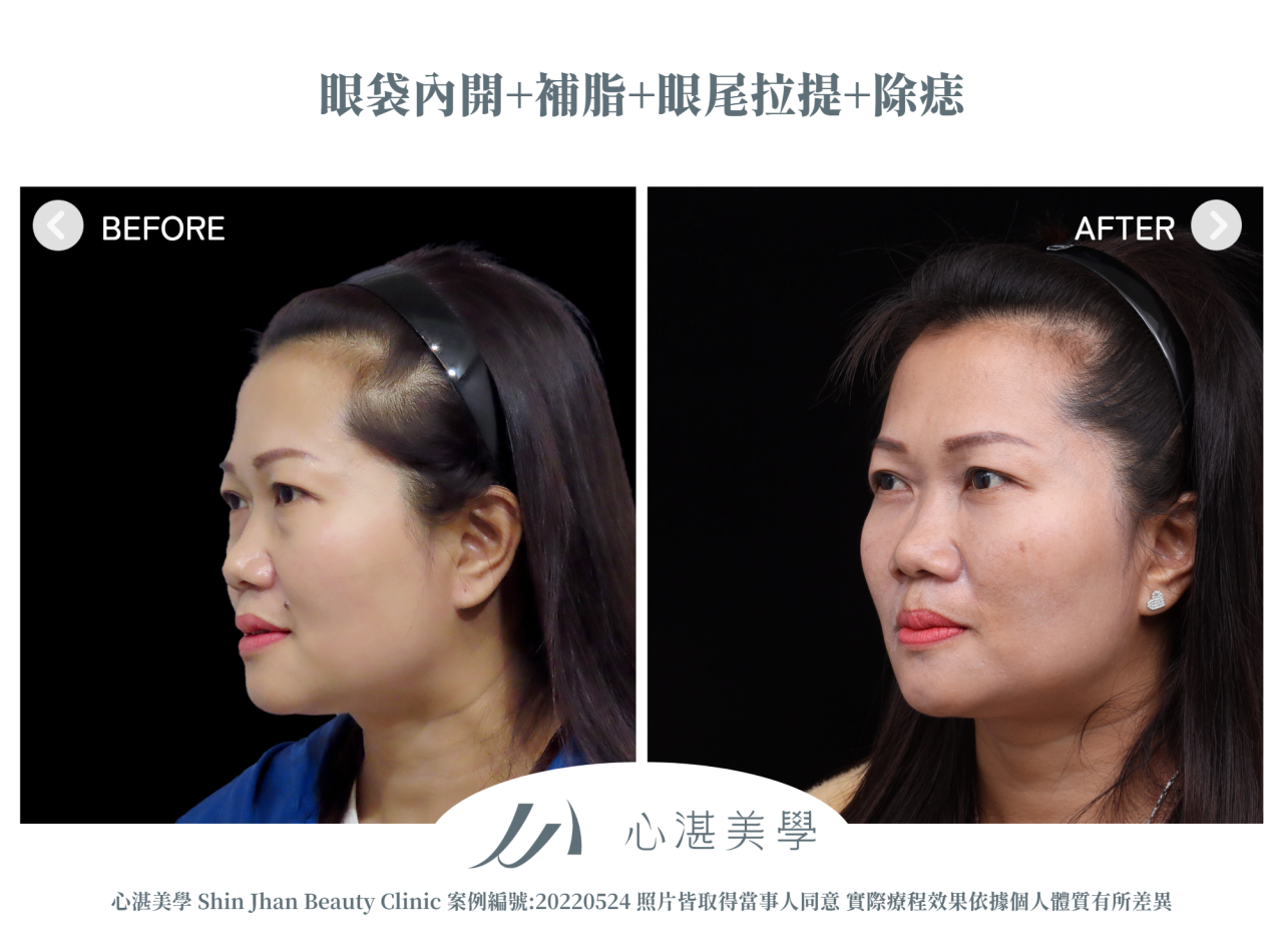 結構式眼袋(眼袋內開+眼尾拉提定位+自體脂肪補淚溝蘋果肌) 術前術後案例分享