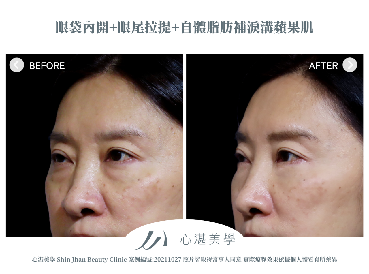結構式眼袋(眼袋內開+眼尾拉提定位+自體脂肪補淚溝蘋果肌) 術前術後案例分享