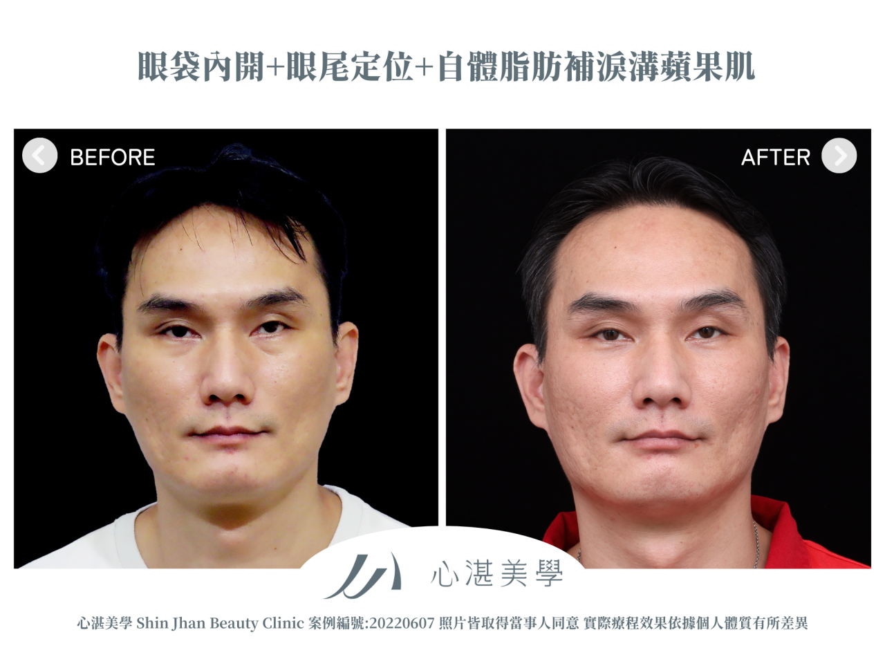 結構式眼袋(眼袋內開+眼尾拉提定位+自體脂肪補淚溝蘋果肌) 術前術後案例分享