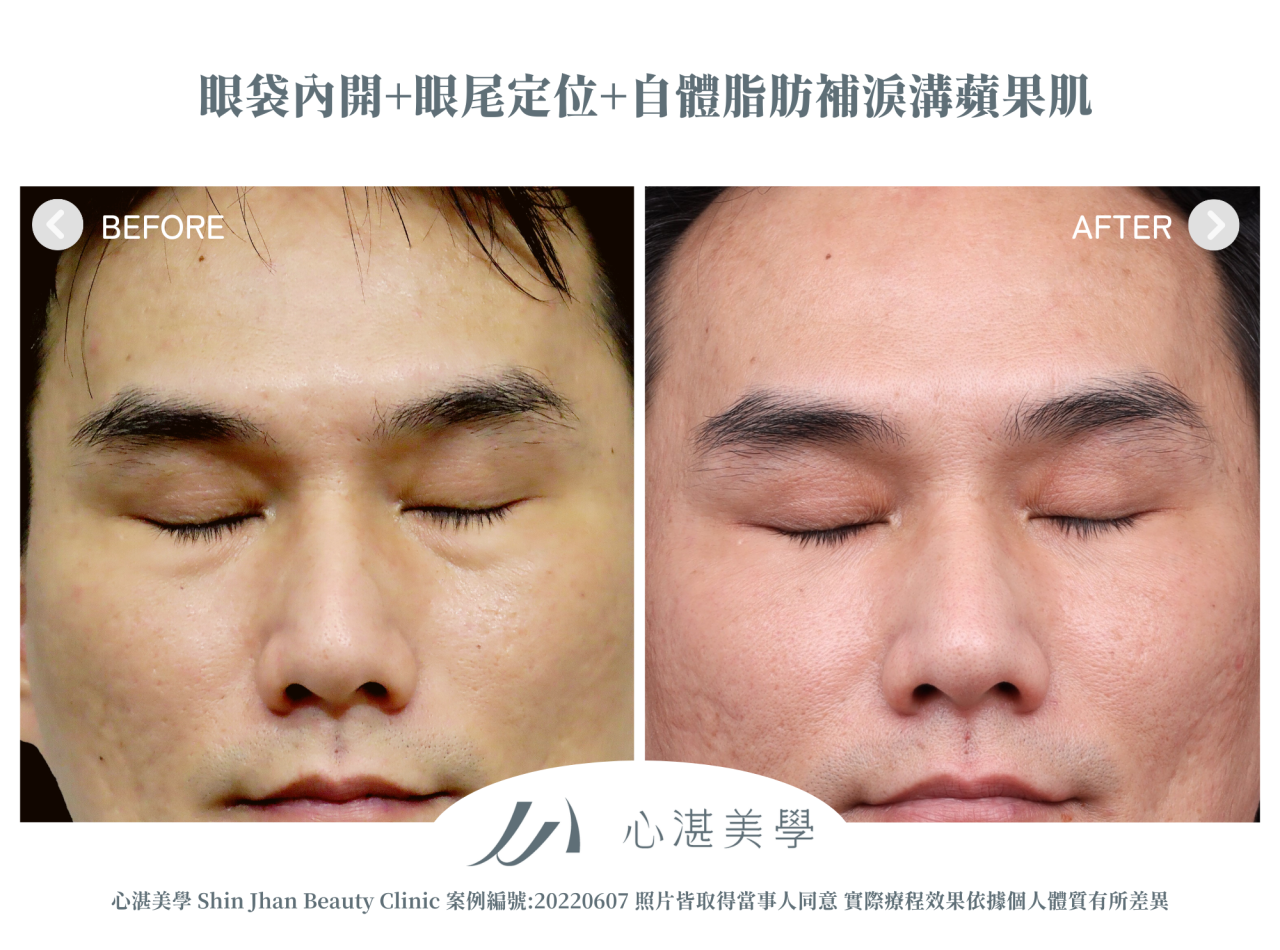 結構式眼袋(眼袋內開+眼尾拉提定位+自體脂肪補淚溝蘋果肌) 術前術後案例分享