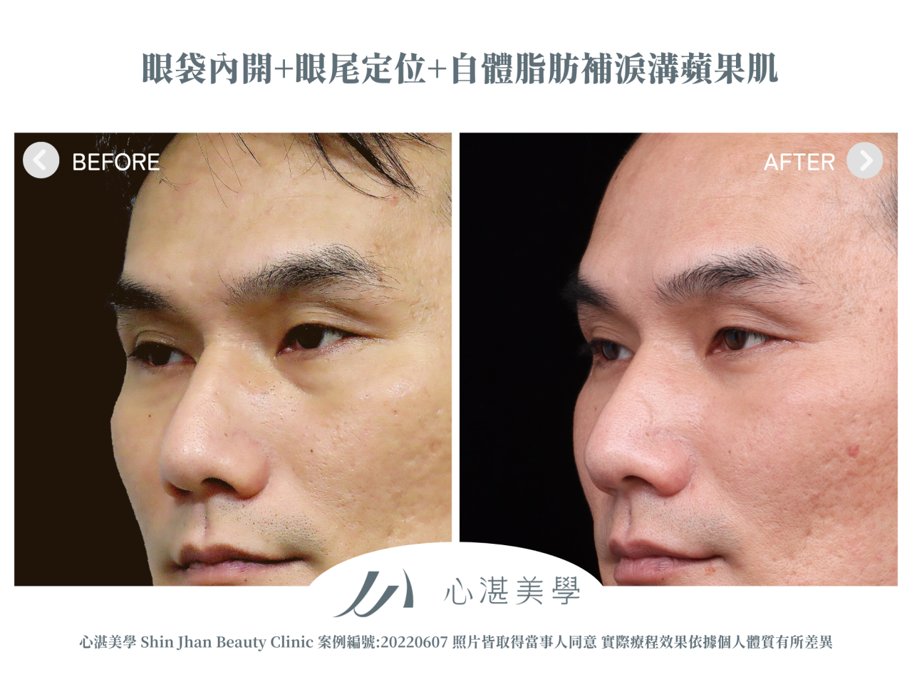 結構式眼袋(眼袋內開+眼尾拉提定位+自體脂肪補淚溝蘋果肌) 術前術後案例分享