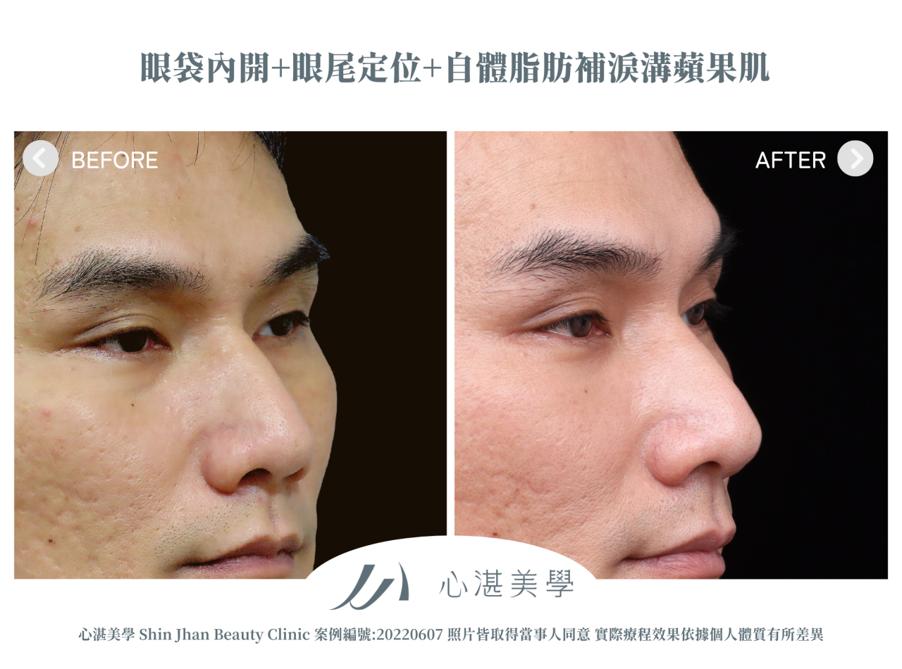 結構式眼袋(眼袋內開+眼尾拉提定位+自體脂肪補淚溝蘋果肌) 術前術後案例分享