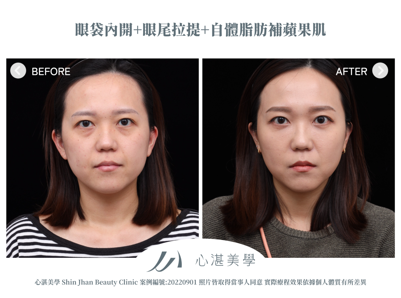 結構式眼袋(眼袋內開+眼尾拉提定位+自體脂肪補淚溝蘋果肌) 術前術後案例分享