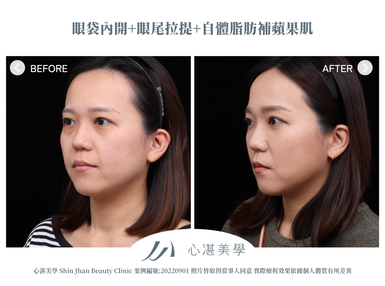 結構式眼袋(眼袋內開+眼尾拉提定位+自體脂肪補淚溝蘋果肌) 術前術後案例分享