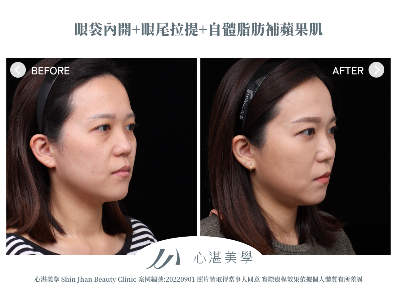 結構式眼袋(眼袋內開+眼尾拉提定位+自體脂肪補淚溝蘋果肌) 術前術後案例分享