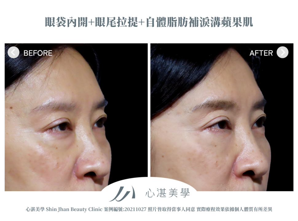 結構式眼袋(眼袋內開+眼尾拉提定位+自體脂肪補淚溝蘋果肌) 術前術後案例分享