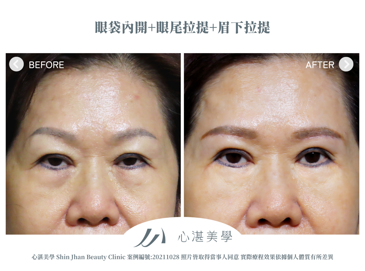 微創提眉術(眉下切皮)+眼袋內開+眼尾拉提定位術前術後案例分享