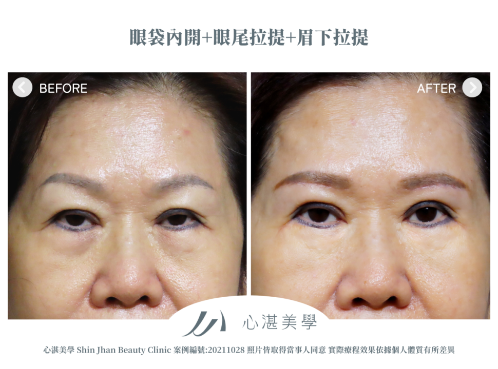 微創提眉術(眉下切皮)+眼袋內開+眼尾拉提定位術前術後案例分享