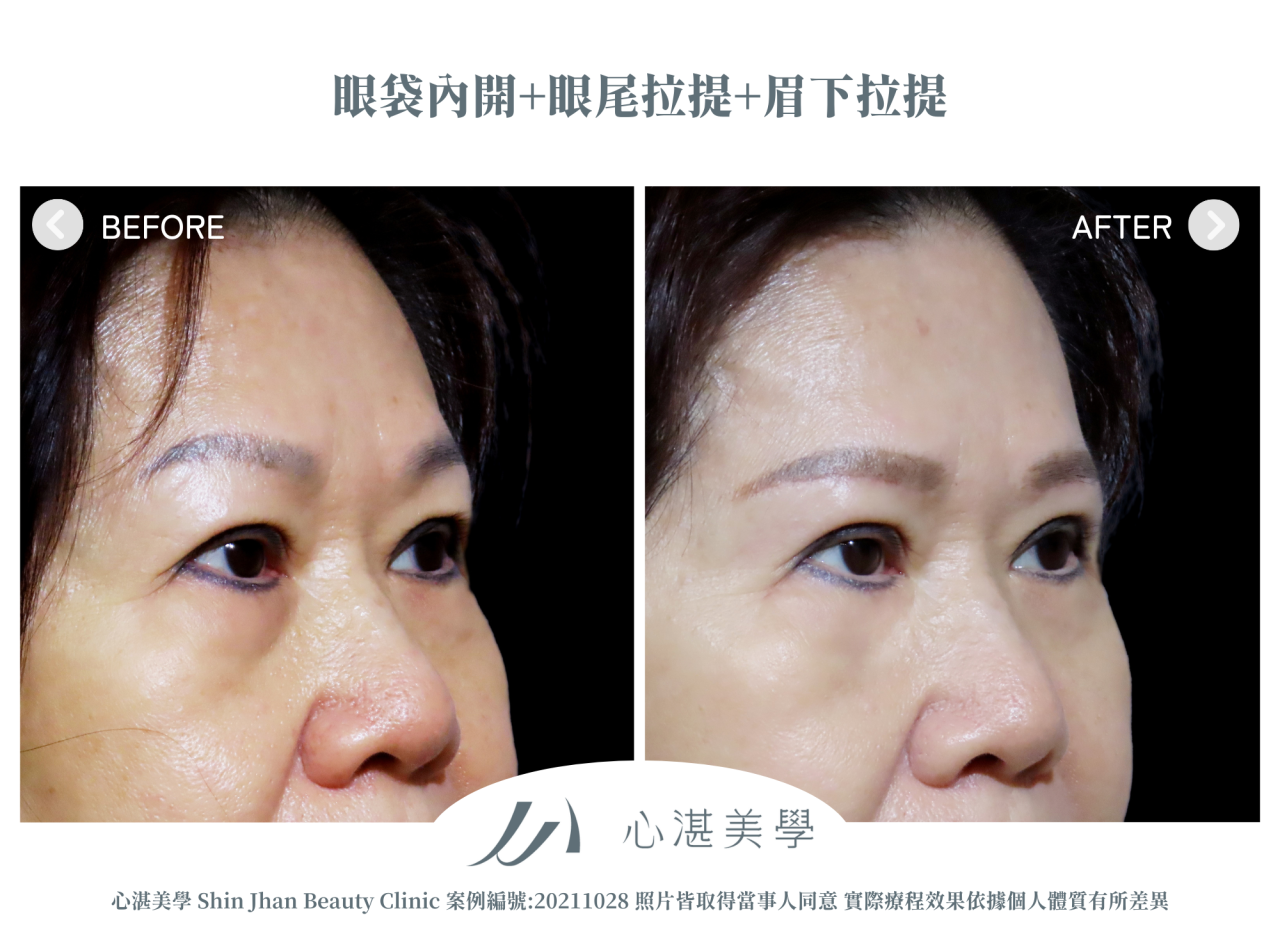 微創提眉術(眉下切皮)+眼袋內開+眼尾拉提定位術前術後案例分享