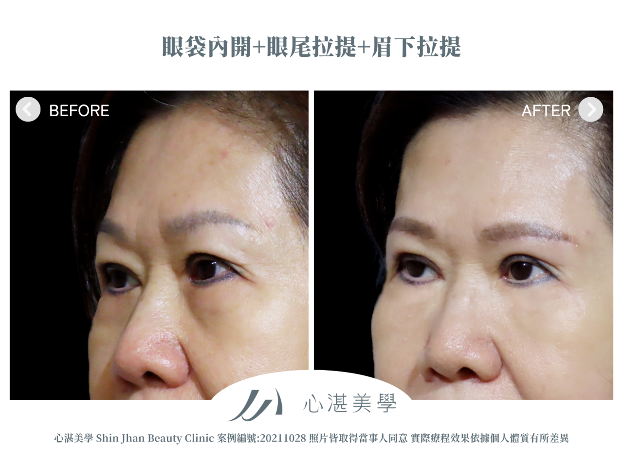 微創提眉術(眉下切皮)+眼袋內開+眼尾拉提定位術前術後案例分享
