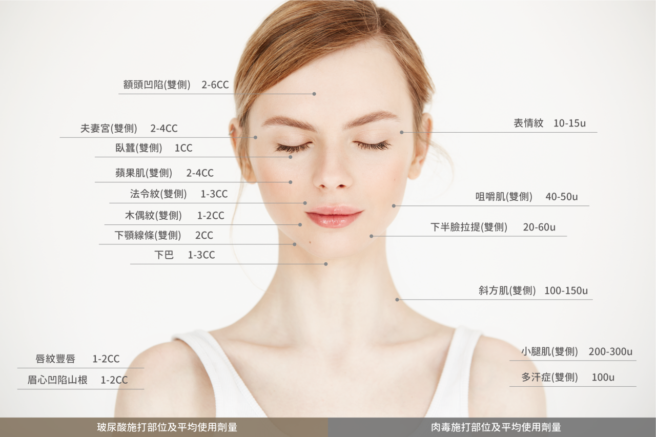 臉部各部位肉毒桿菌素和玻尿酸的建議注射劑量與應用區域示意圖。清晰標示額頭、表情紋、下巴、V臉拉提等常見美容注射點位，提供消費者和專業人士關於臉部抗衰老和塑形治療的實用參考資訊。