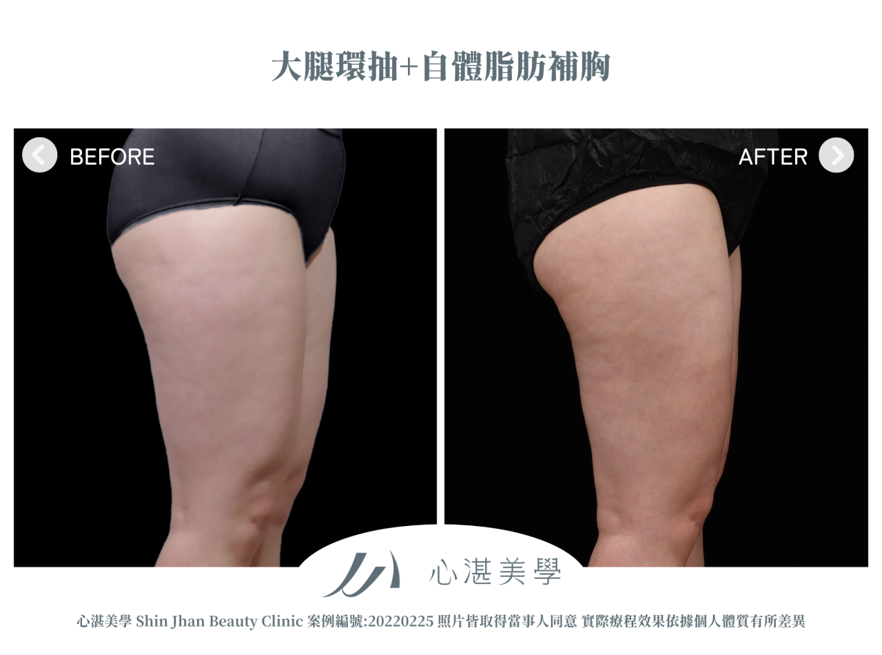 PAL大腿環抽+超能電漿 術前術後案例分享