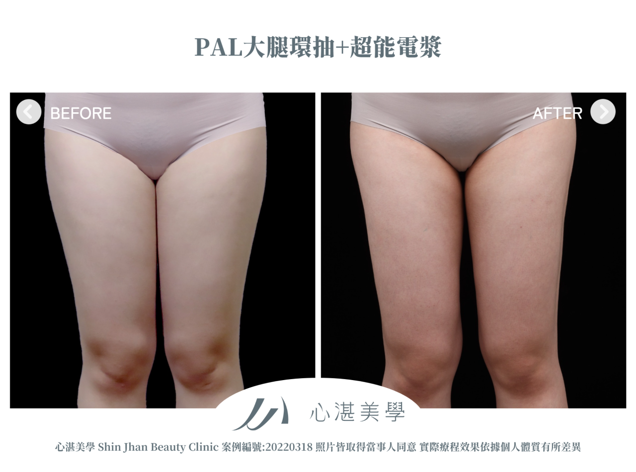 PAL大腿環抽+超能電漿 術前術後案例分享