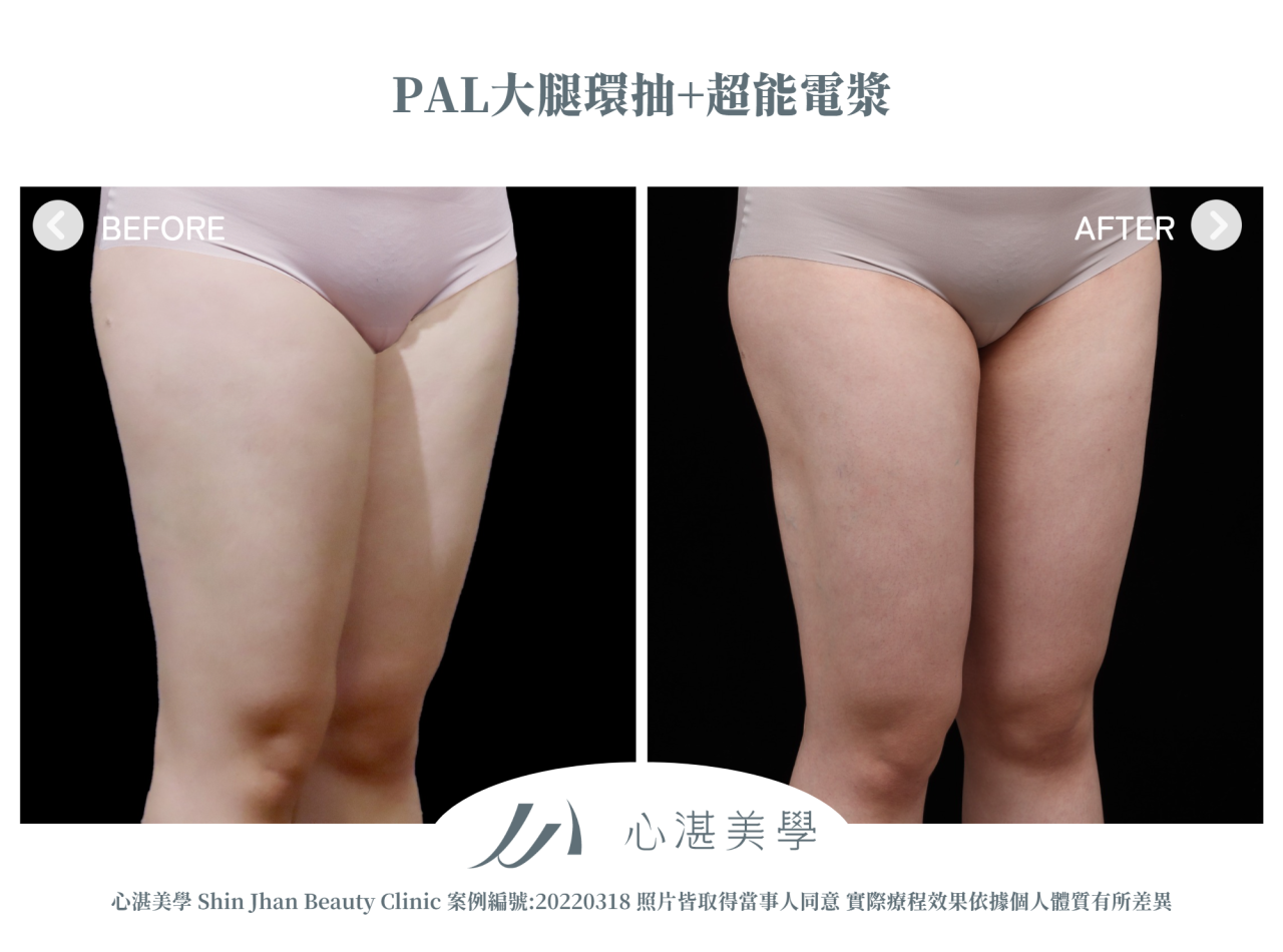PAL大腿環抽+超能電漿 術前術後案例分享