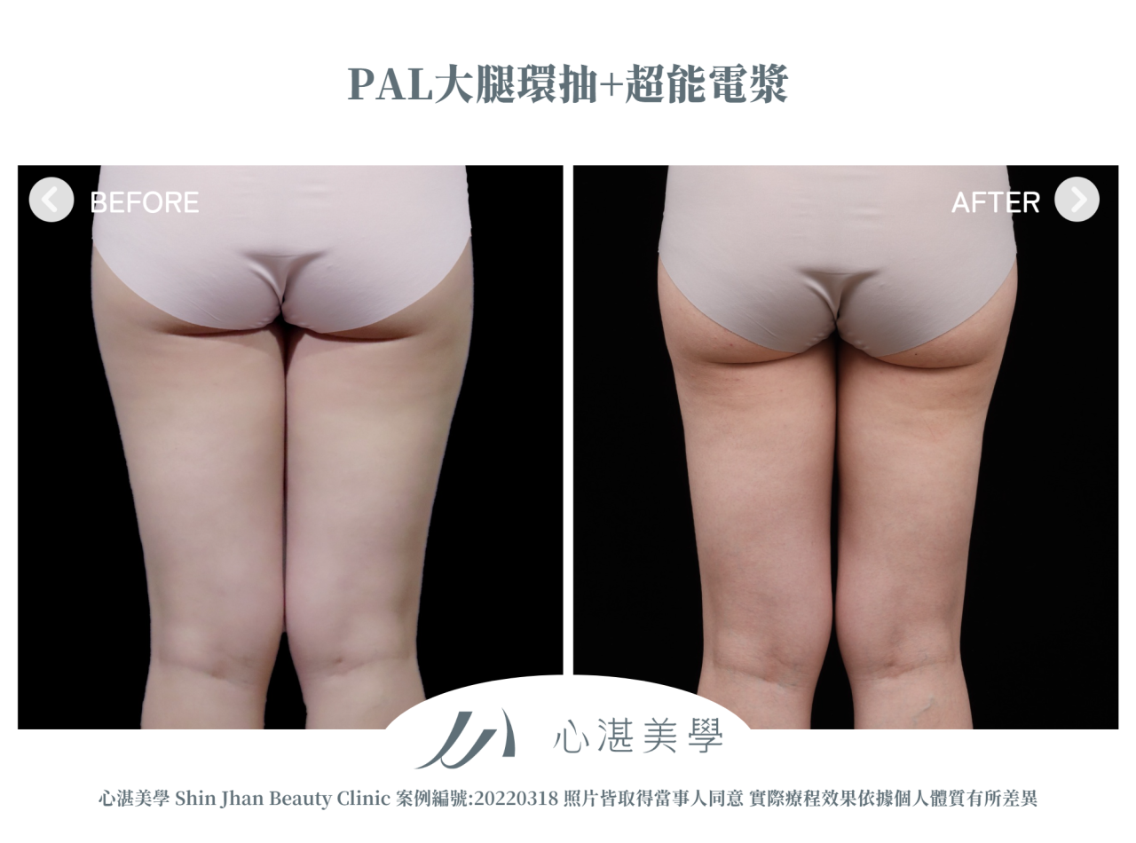PAL大腿環抽+超能電漿 術前術後案例分享